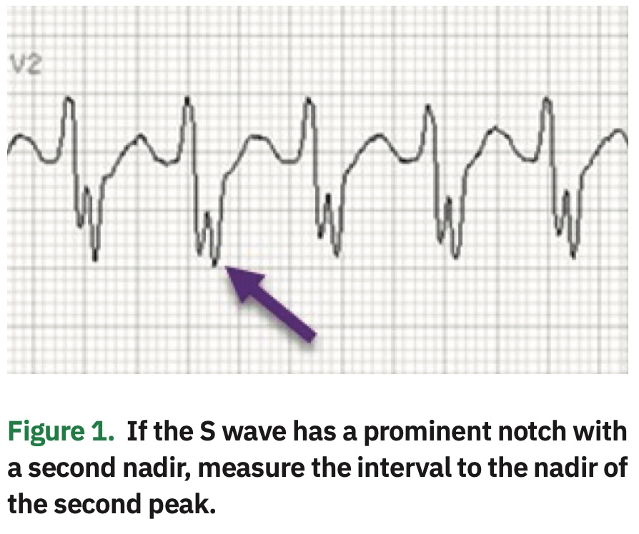 Wide Complex Tachycardias: Making the Brugada Criteria More User Friendly